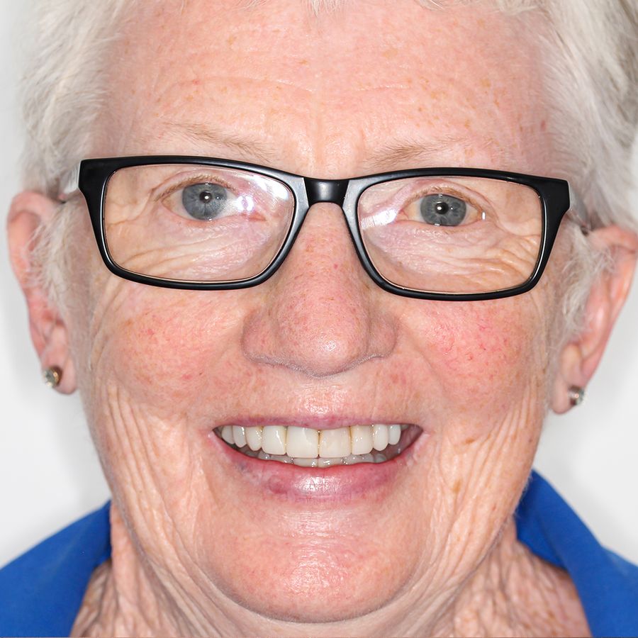 composite veneers smile 26
